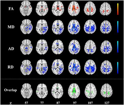 Alterations of the White Matter in Patients With Knee Osteoarthritis: A Diffusion Tensor Imaging Study With Tract-Based Spatial Statistics